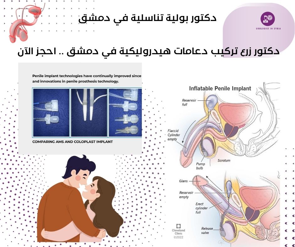 دكتور تركيب دعامات هيدروليكية للعضو الذكري في دمشق 