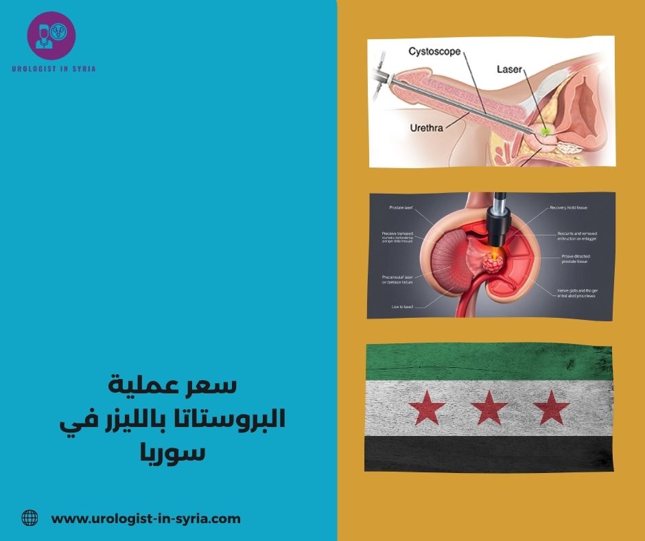 سعر عملية البروستاتا بالليزر في سوريا