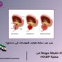 مين جرب عملية هوليب للبروستات في دمشق؟