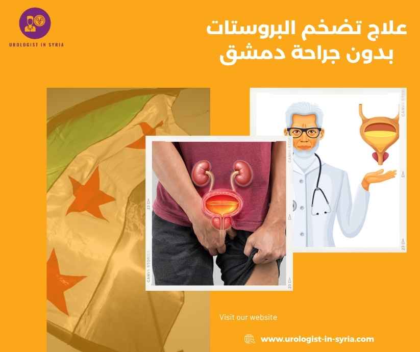 علاج تضخم البروستات بدون جراحة دمشق 