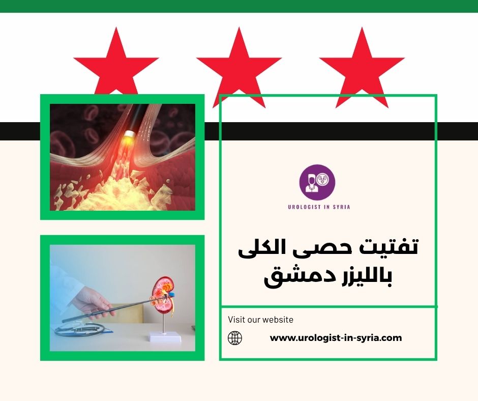 تفتيت حصى الكلى بالليزر دمشق