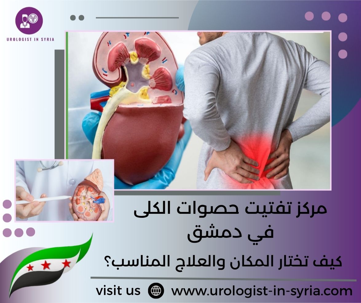 مركز تفتيت حصوات الكلى في دمشق