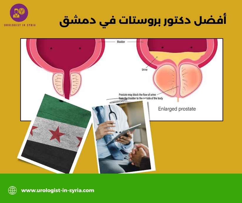 أفضل دكتور بروستات في دمشق أفضل دكتور بروستات في دمشق