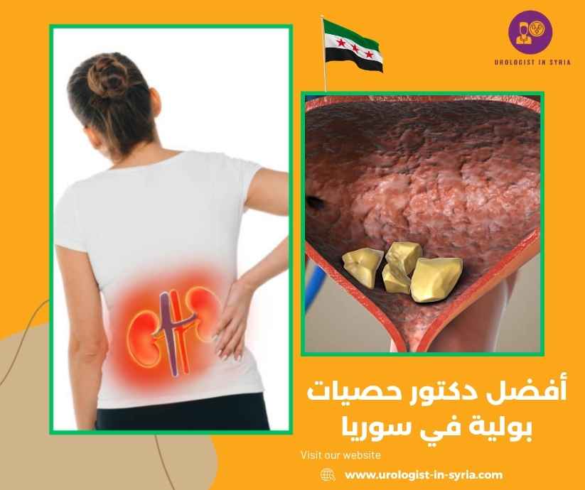 أفضل دكتور حصيات بولية في سوريا أفضل دكتور حصيات بولية في سوريا