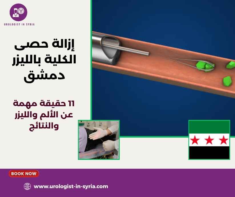 إزالة حصى الكلية بالليزر دمشق