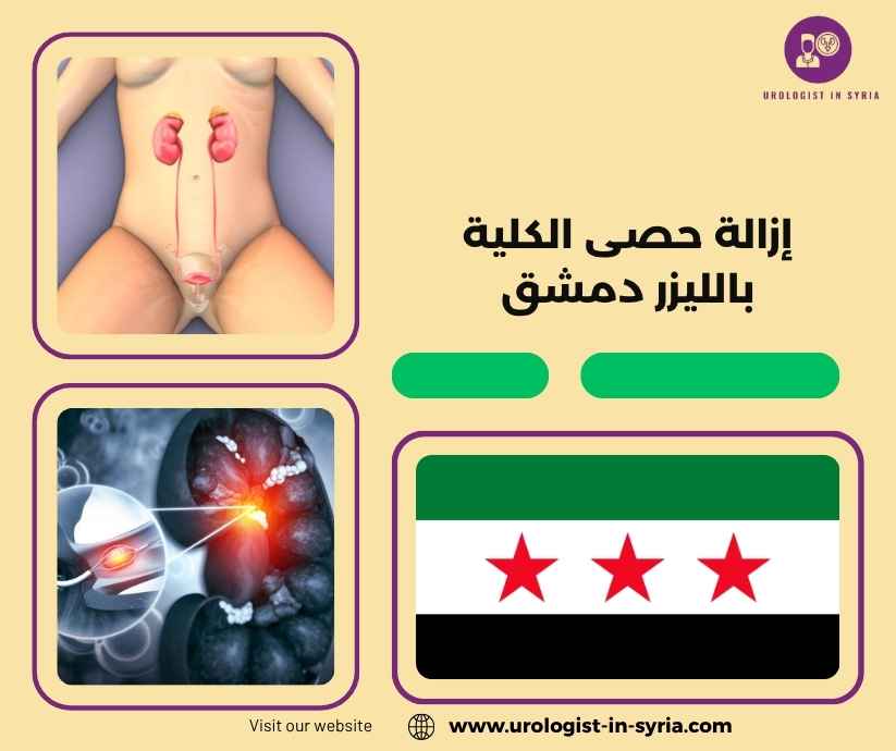إزالة حصى الكلية بالليزر دمشق