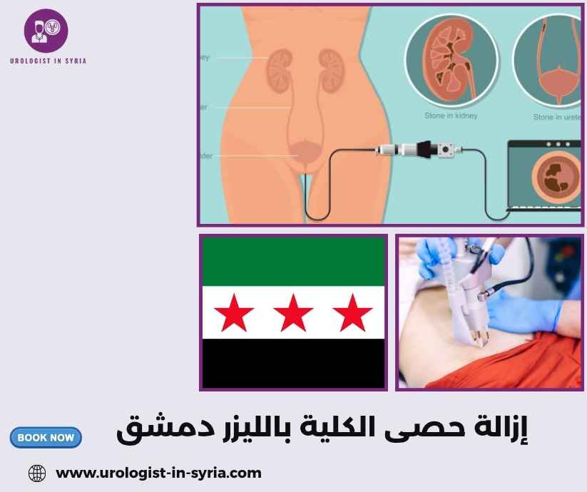 إزالة حصى الكلية بالليزر دمشق