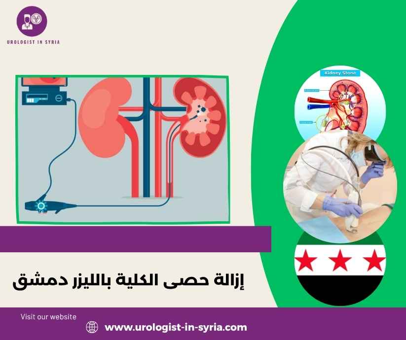 إزالة حصى الكلية بالليزر دمشق