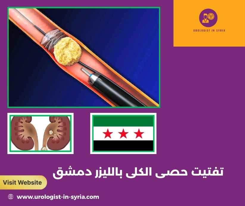 تفتيت حصى الكلى بالليزر دمشق