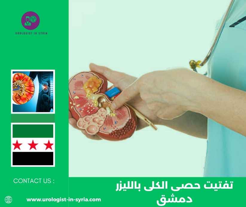 تفتيت حصى الكلى بالليزر دمشق