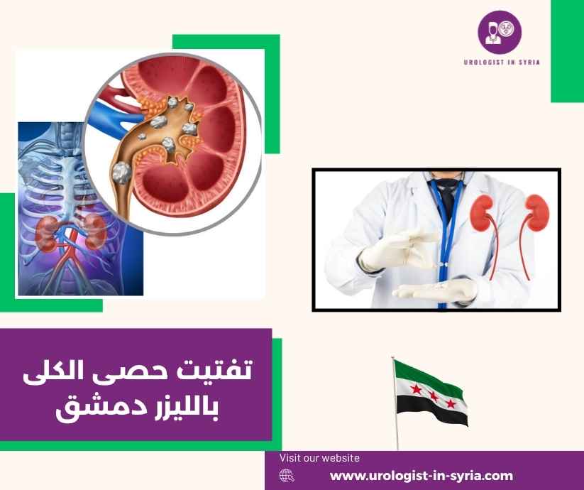 تفتيت حصى الكلى بالليزر دمشق