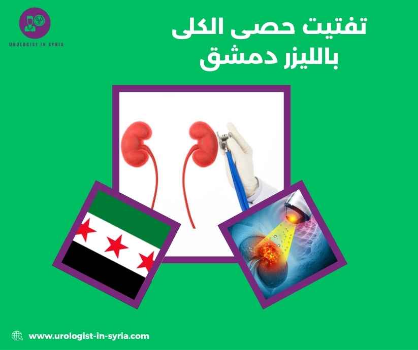 تفتيت حصى الكلى بالليزر دمشق