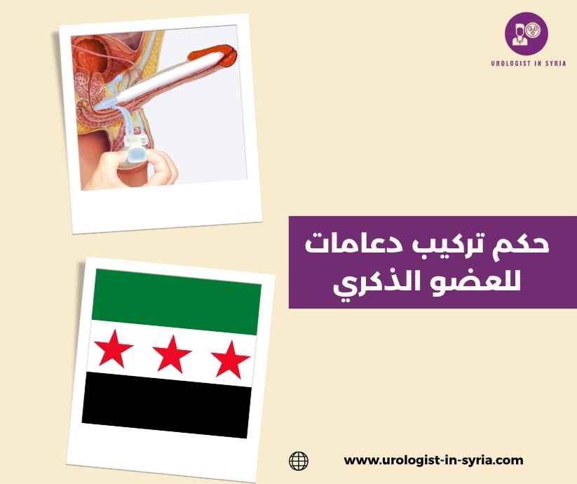 حكم تركيب دعامات للعضو الذكري