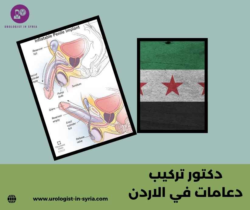 دكتور تركيب دعامات في الاردن