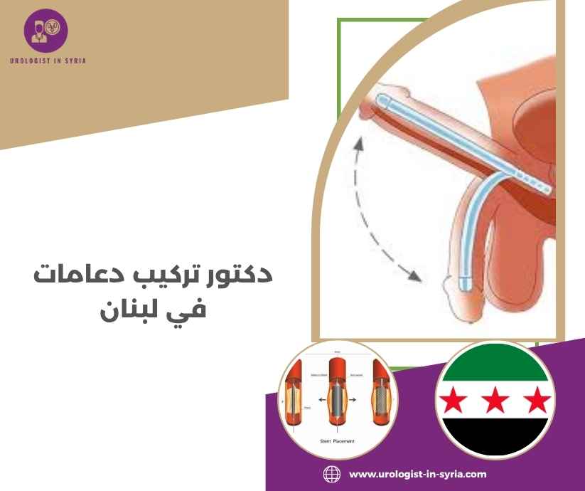دكتور تركيب دعامات في لبنان