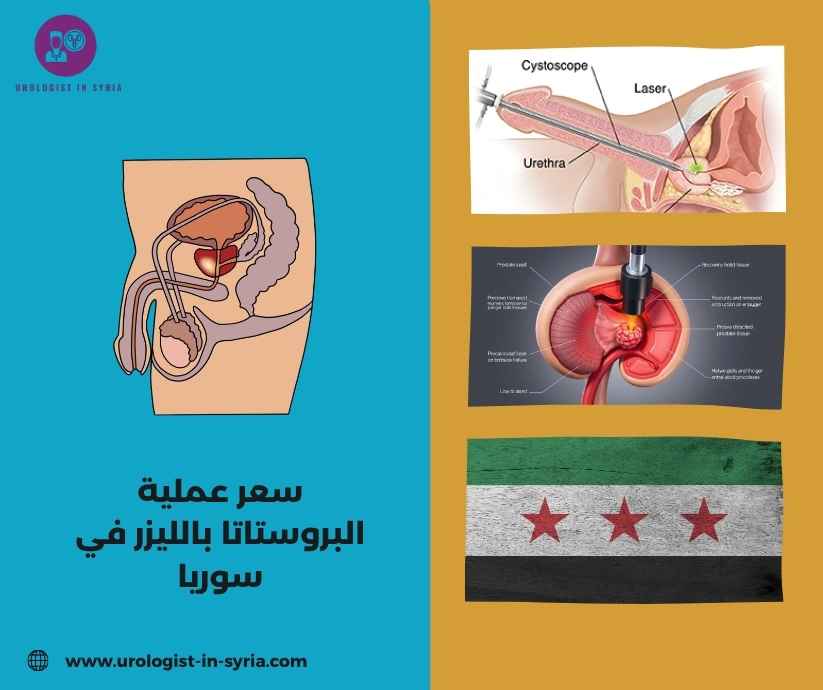 سعر عملية البروستاتا بالليزر في سوريا