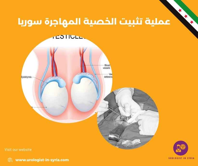 عملية تثبيت الخصية المهاجرة سوريا