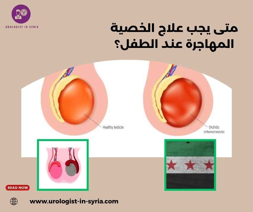متى يجب علاج الخصية المهاجرة عند الطفل؟ متى يجب علاج الخصية المهاجرة عند الطفل؟