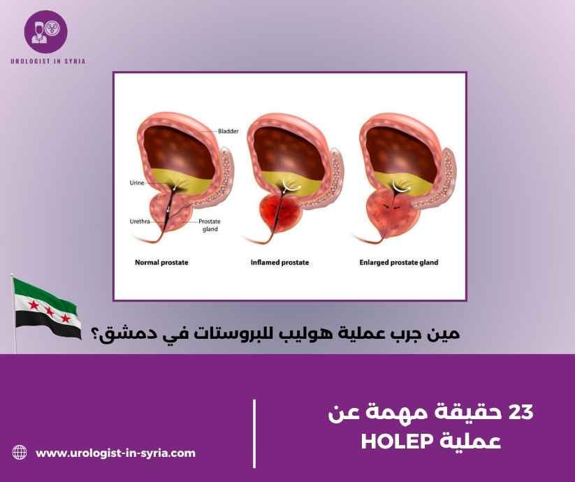 مين جرب عملية هوليب للبروستات في دمشق؟